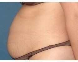Avant abdominoplastie: patiente présentant un diastasis majeur dû à une grossesse gémellaire