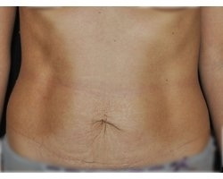 Avant abdominoplastie: patiente présentant un relâchement cutané