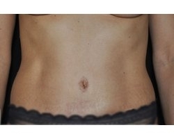Après abdominoplastie: remise en tension de la peau du ventre