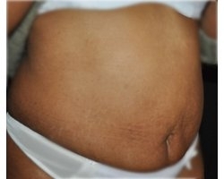 Avant abdominoplastie: patiente présentant un relâchement cutané et une surcharge graisseuse