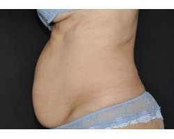 Avant lipectomie abdominale : patiente présentant un relâchement cutané et diastasis des droits