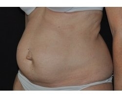 Avant lipectomie abdominale : patiente présentant un diastasis des droits majeur