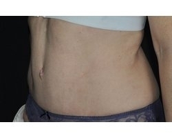 Après lipectomie abdominale: correction du diastasis