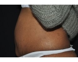 Avant abdominoplastie: patiente présentant un relâchement cutané et une surcharge graisseuse