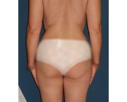 Après opération lipoaspiration Après opération lipoaspiration