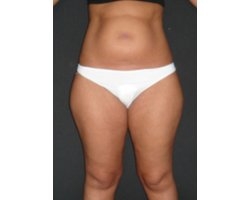 Avant opération lipoaspiration Avant opération lipoaspiration
