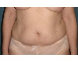 Avant opération liposuccion Avant opération liposuccion