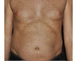 Avant opération liposuccion Avant opération liposuccion