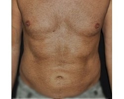 Après opération liposuccion Après opération liposuccion
