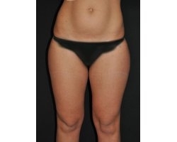 Avant opération liposuccion Avant opération liposuccion