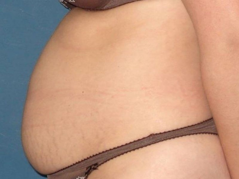 Fond Deux Photos Avec Trois Tailles Différentes Du Ventre Dune Femme Fond,  Photos De Ventres De Femmes Enceintes Après Une Abdominoplastie, Ventre,  Enceinte Image de Fond Pour le Téléchargement Gratuit - Pngtree