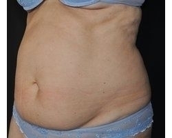 Photo Avant abdominoplastie