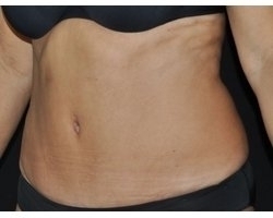 Photo Après abdominoplastie