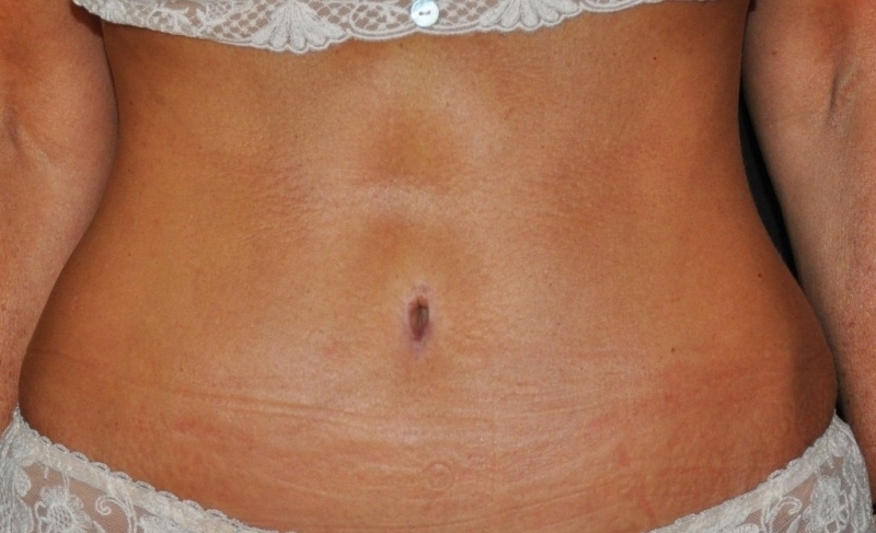 Fond Deux Photos Avec Trois Tailles Différentes Du Ventre Dune Femme Fond,  Photos De Ventres De Femmes Enceintes Après Une Abdominoplastie, Ventre,  Enceinte Image de Fond Pour le Téléchargement Gratuit - Pngtree