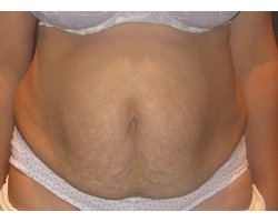 Avant lipectomie abdominale : patiente présentant un relâchement cutané et diastasis des droits