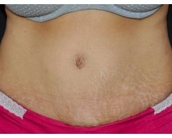 Après lipectomie abdominale: remise en tension de la peau du ventre et correction du diastasis