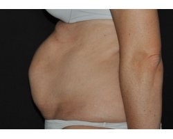 Avant abdominoplastie: patiente présentant un diastasis majeur dû à une grossesse gémellaire