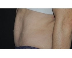 Après abdominoplastie: correction du diastasis