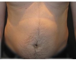 Avant opération lipoaspiration