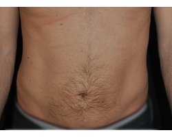 Après opération lipoaspiration