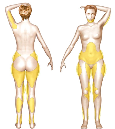 Lipoaspiration Marseille chirurgie esthetique